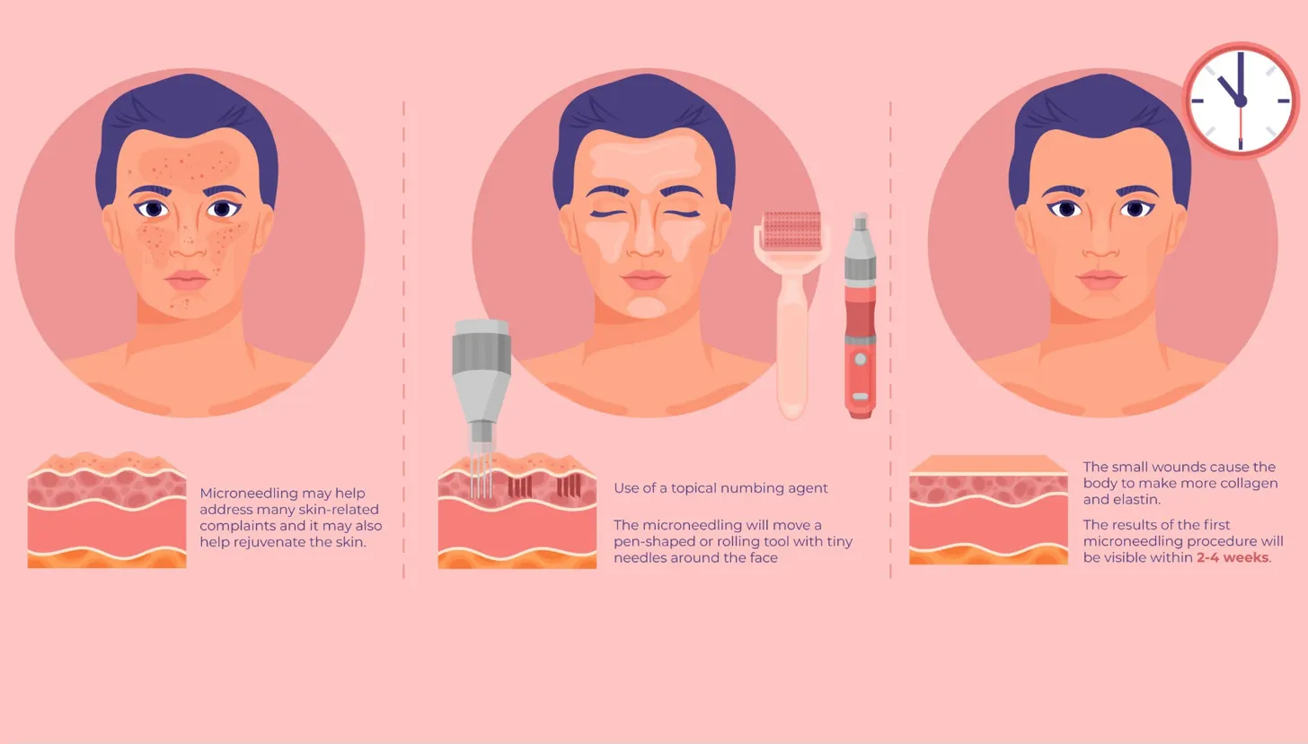Morpheus8 Radiofrequency Microneedling