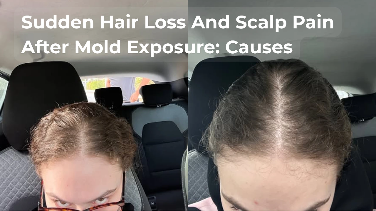 Sudden Hair Loss And Scalp Pain After Mold Exposure: Causes